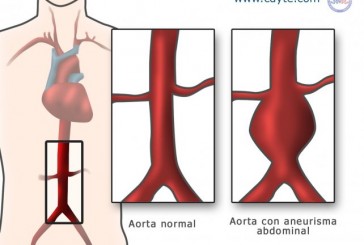 Aneurisma de aorta: su diagnóstico temprano y tratamiento