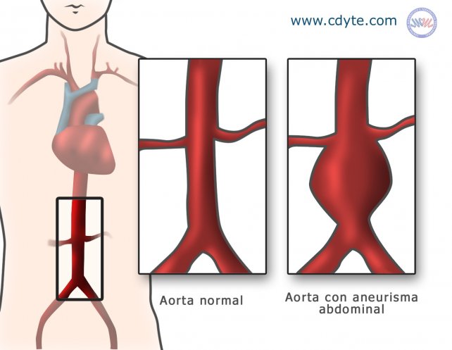 Aneurisma de aorta: su diagnóstico temprano y tratamiento