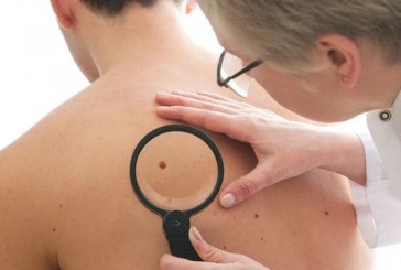 Melanoma: cómo detectar en los lunares una potencial amenaza de cáncer de piel