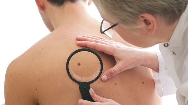 Melanoma: cómo detectar en los lunares una potencial amenaza de cáncer de piel