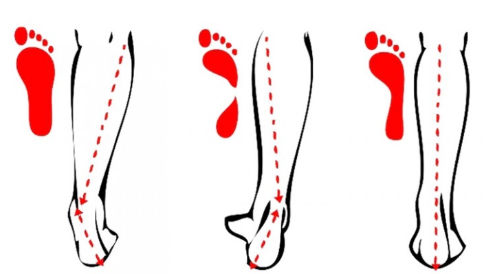 Los tipos de pisada y cómo se desvía la pierna