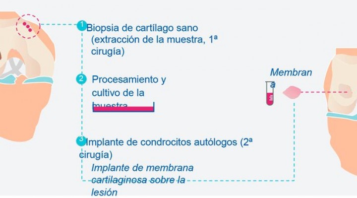 Un dibujo que explica como se realiza el implante en el cartílago para evitar futuras lesiones en la zona afectada