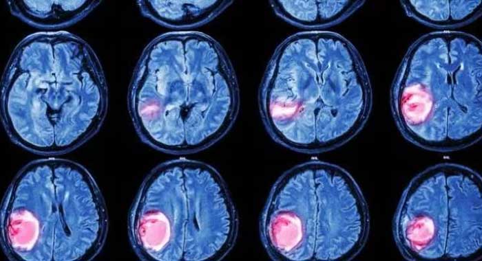 Crean un casco magnético capaz de encoger tumores cerebrales